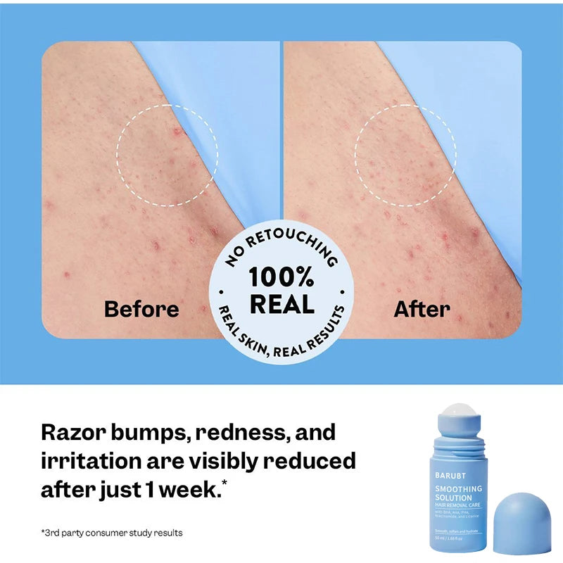 DermaEase: Smoothing Solution Ingrown Hair Treatment